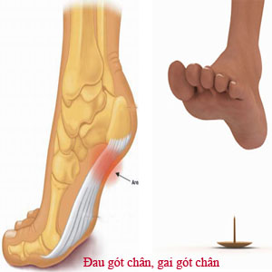 Gai xương gót chân - Hình ảnh minh họa